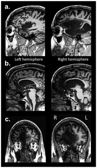 Illustration for article titled Rare neurological patient shows that self-awareness does not require a complex brain